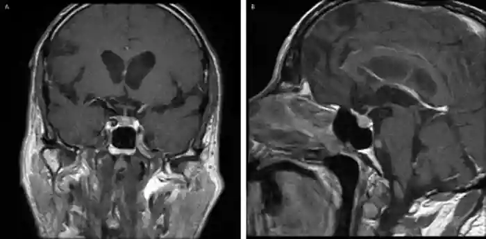 Figure. T1–weighted MRI with gadolinium in the same patient as described in the Table demonstrated a modest diffuse enlargement of the pituitary gland for his age, with some heterogeneity of contrast enhancement across the gland, consistent with hypophysitis.