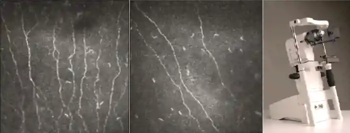 Figure 1. Corneal confocal microscopy in healthy normoglycaemic volunteer (left panel) and in an individual with established diabetic neuropathy (middle panel). A Heidelburg HRT3 corneal confocal microscope with corneal module (right panel). &#169;Sanjeev Sharma, Ipswich Hospital