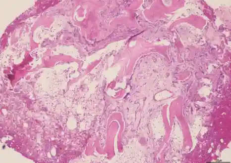 Figure 3. Bone biopsy showing core of cancellous bone trabeculae forming a mixture of viable bone and new reactive woven bone. There is a patchy infiltrate of neutrophils and plasma cells. The features are of subacute bacterial osteomyelitis. &#169;Dr John Salisbury, King’s College Hospital