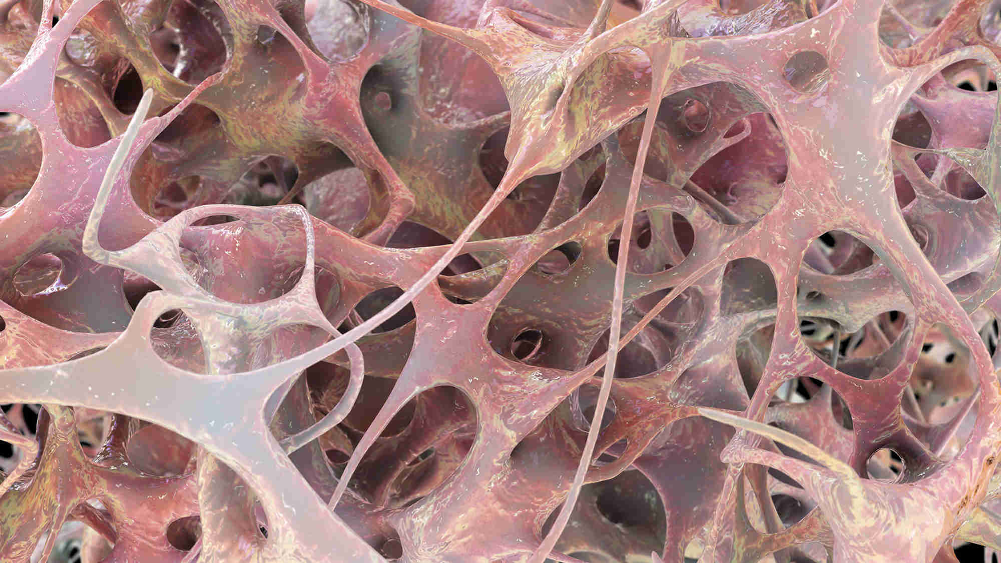 3D illustration of osteoporotic trabecular bone. Credit: shutterstock