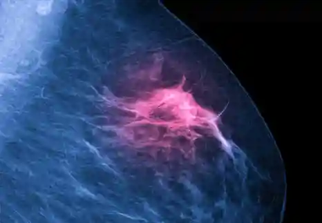 Mammogram radio imaging for breast cancer diagnosis. &#169;Shutterstock