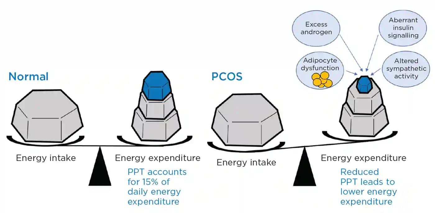 Figure. Post-prandial energy expenditure (thermogenesis; PPT) is reduced in women with PCOS and contributes to obesity. The probable mechanism(s) of reduced PPT involve(s) an interaction of several factors including excess androgen action, adipocyte dysfunction, aberrant insulin signalling (including in the brain) and altered sympathetic nervous system activity, both in fat and centrally.