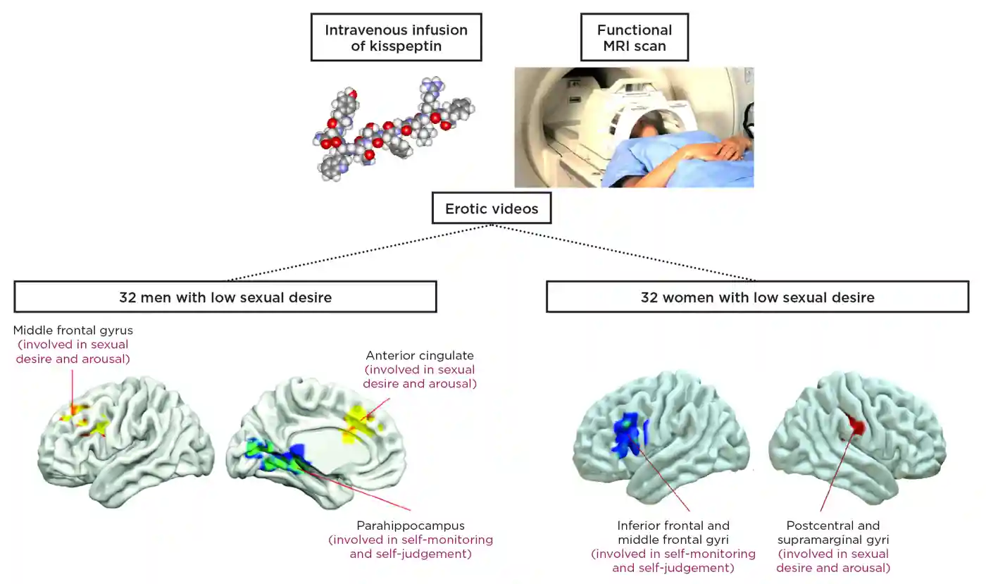 Figure. Effects of kisspeptin on fMRI sexual brain activity while watching erotic videos: 32 men and 32 women with low sexual desire attended for 2 study visits (once for a 75-min infusion of kisspeptin and again for a rate-matched placebo), as part of a randomised and blinded-protocol. Red and yellow areas show activation to erotic videos during kisspeptin administration compared with placebo. Blue and green show relative deactivation to erotic videos during kisspeptin administration compared with placebo.