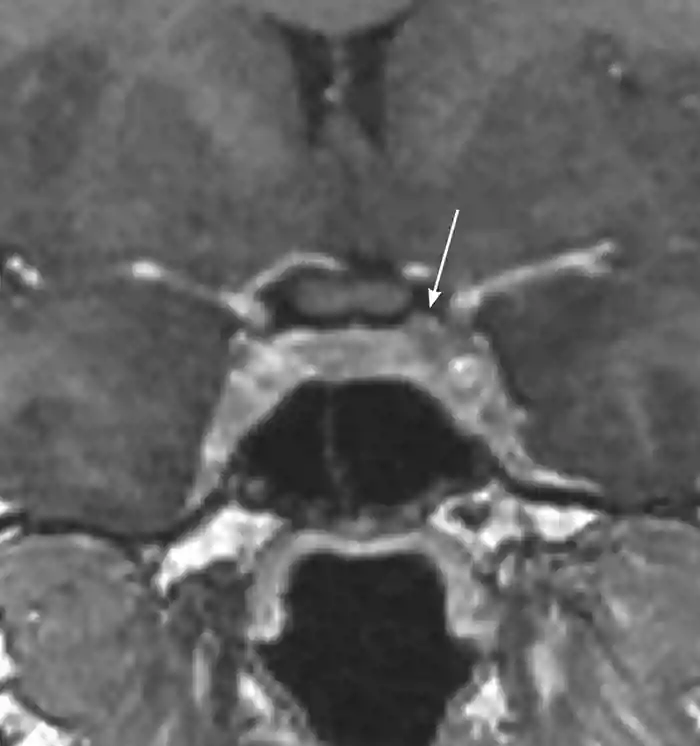 MRI scan of a microprolactinoma