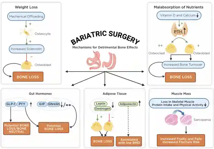 Figure. Possible theories to explain bone loss after bariatric surgery. PTH, parathyroid surgery; +, stimulate; –, inhibit. Created using BioRender.